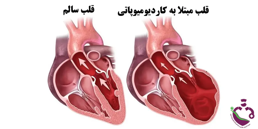 بیماری قلبی کاردیومیوپاتی چیست؟